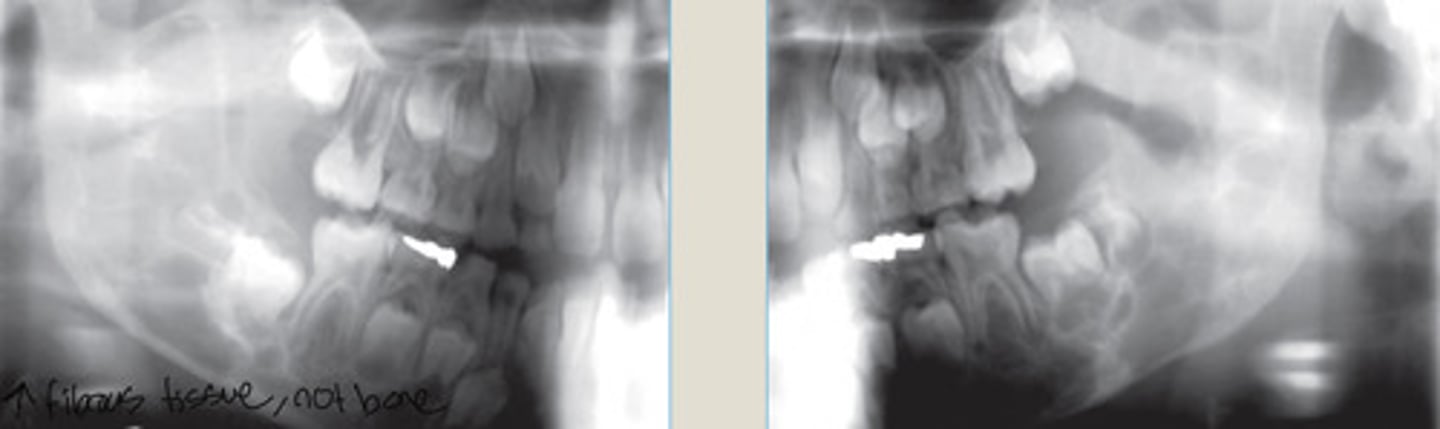 <p>bilateral/symmetric, MN involvement</p>