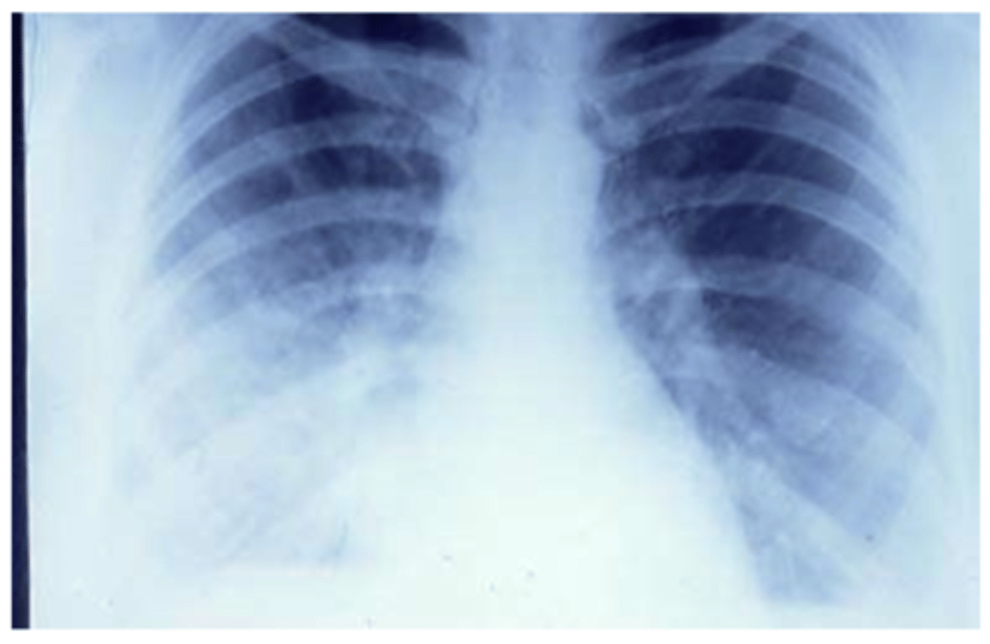 <p>symptoms of a lower respiratory tract infection. </p><p>cough, sputum , breathlessness, chest pain. </p><p>CXR evidence of pneumonia. </p>