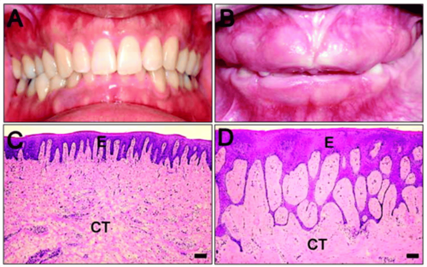 <p>gingival fibromatosis</p>