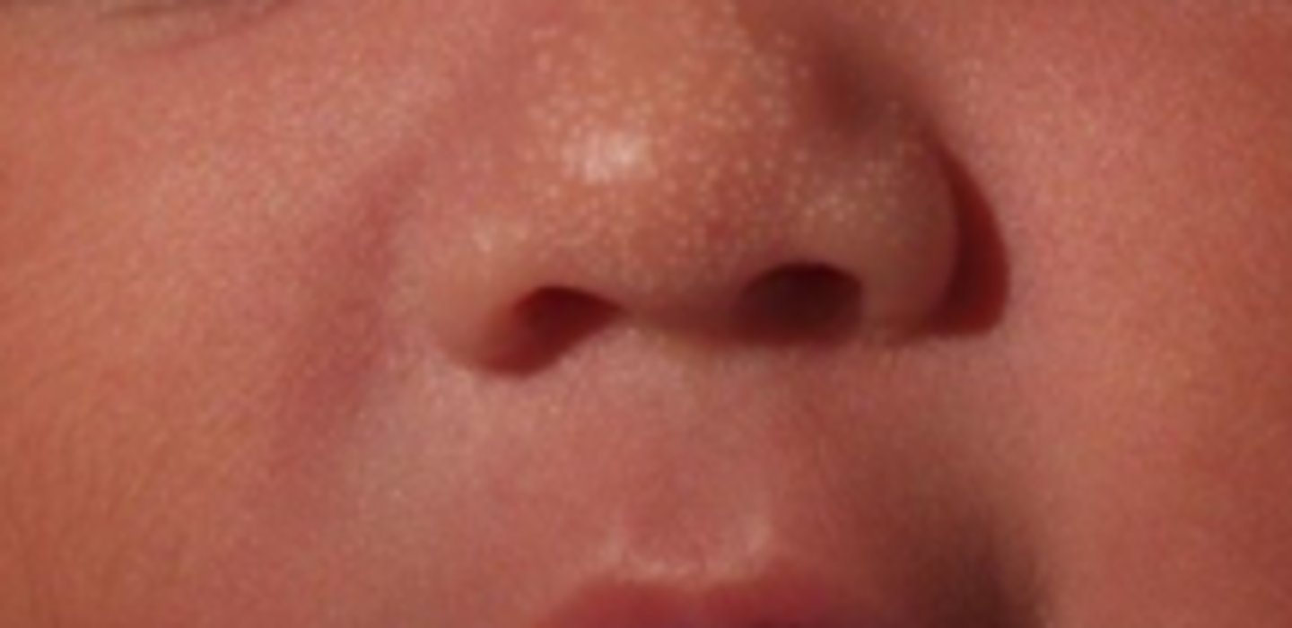 <p>little whiteheads on nose and upper lip</p><p>due to androgens inutero</p><p>resolves spont.</p>