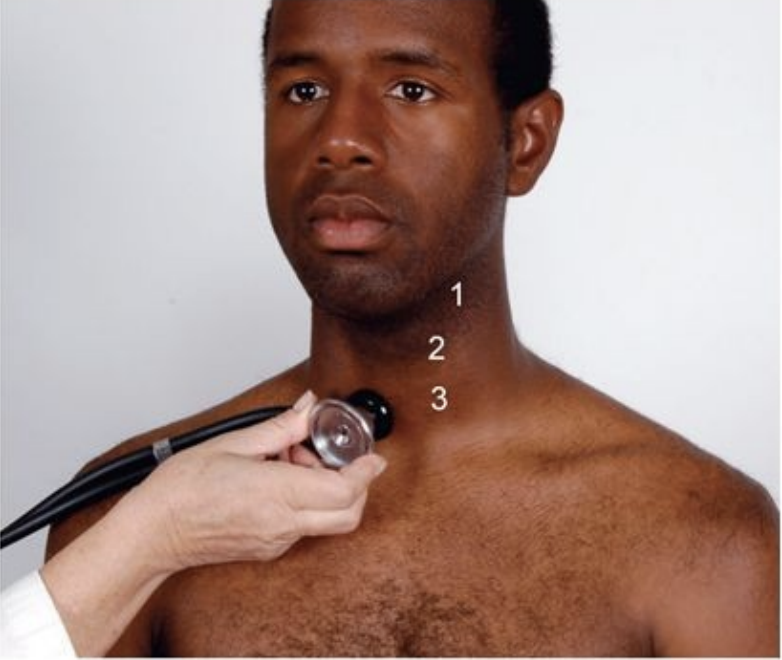 <p>whooshing sound indicating turbulent flow in the carotid artery</p>