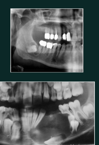 <p>Developmental/odontogenic RL lesions</p><p>RL attached at CEH of an unerupted tooth</p><p>well defined, often corticated</p><p>displaces teeth</p><p>most common with mandibular 3rds and maxillary canines </p>