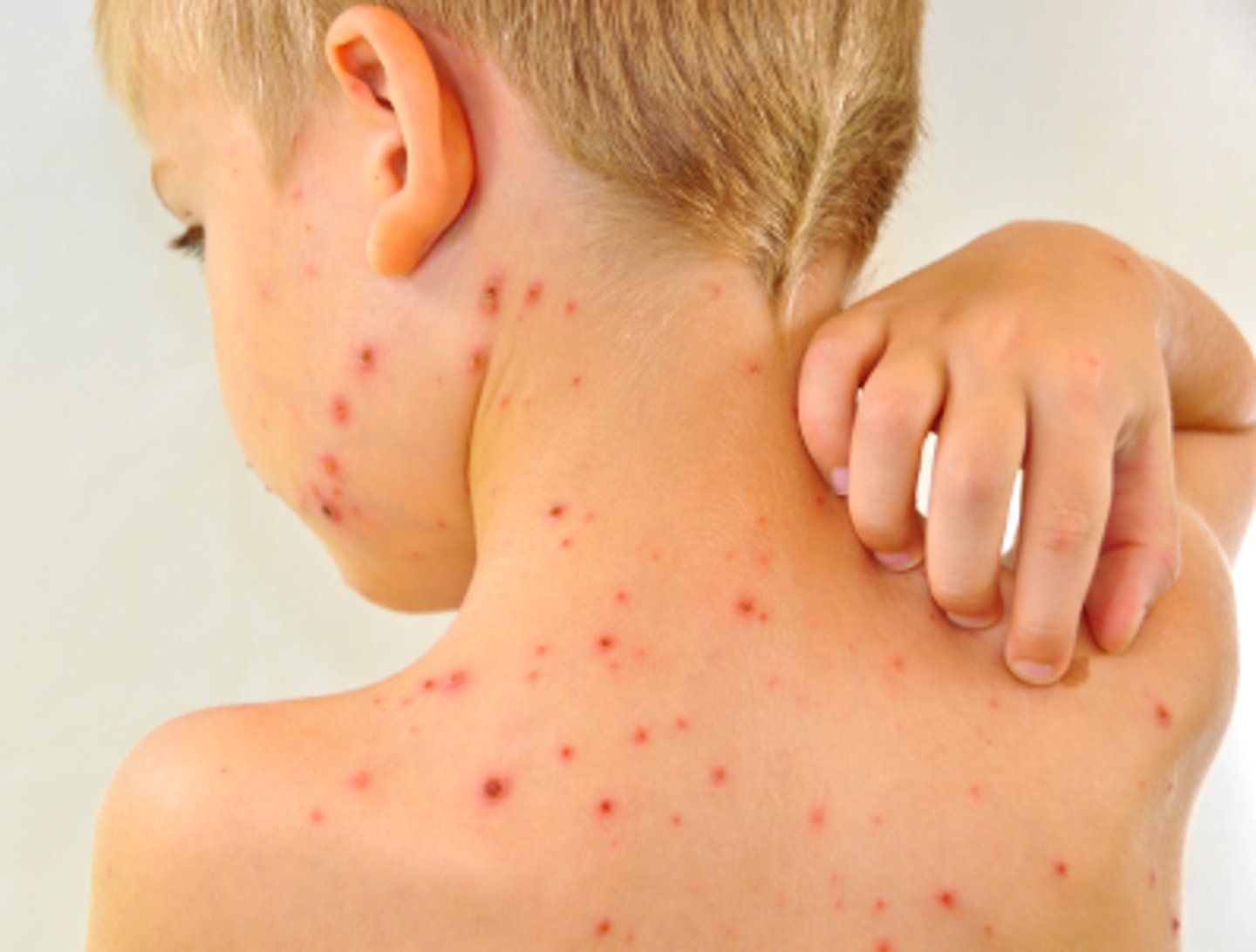 <p>Also known as varicella</p>