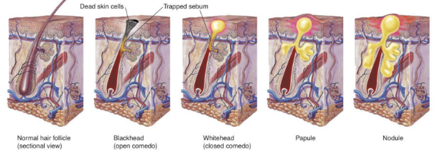 <ul><li><p>Acne is the most common skin disease in the world</p></li><li><p>Chronic inflammatory condition involving </p></li><li><p>Propionibacterium acnes</p></li></ul><p></p>