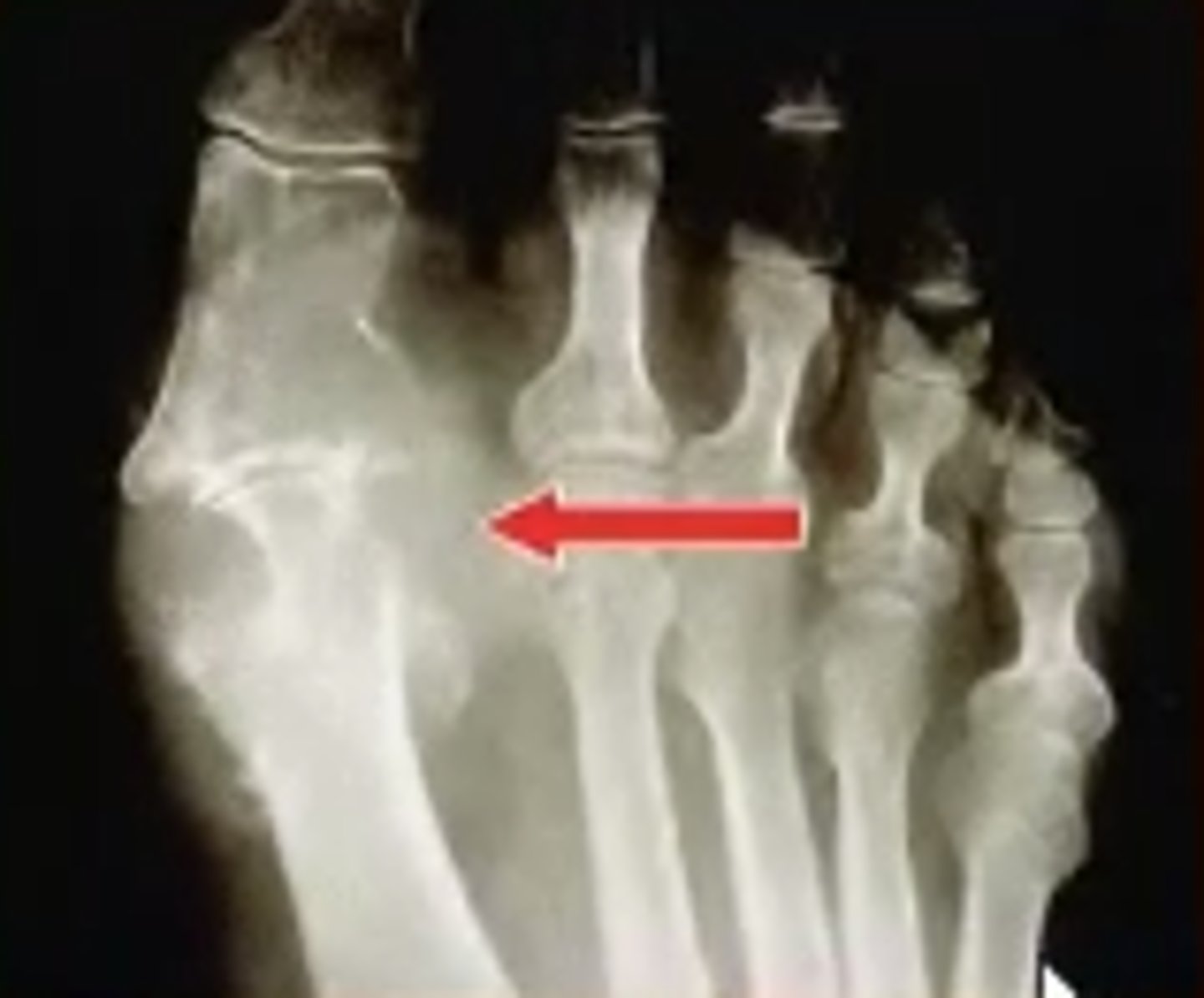 <p><strong>_________</strong> – involves the 1st MCP joint</p>