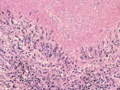 <p>What kind of necrosis is this</p>