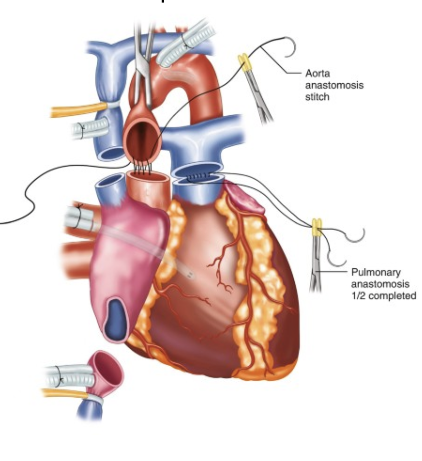 <p>Echocardiogram to evaluate the structure/function of the ventricles and ejection fraction</p><p>Medications: ACEi, aldosterone antagonists, diuretics, beta blockers, and CCBs</p><p class="p1">Surgical interventions: cardiac transplantation</p><p class="p1">Ventricular assist devices:</p><ul><li><p class="p1">Bridge to transplantation</p></li><li><p class="p1">Sustain life until donor heart becomes available- Destination therapy in patients with end-stage heart failure who are ineligible for transplant and for whom ventricular recovery is not possible</p></li></ul><p class="p1">Orthotopic heart transplantation: most common surgical procedure</p><p></p>