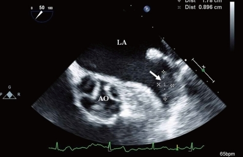 <p>The TEE image of the left atrial appendage revealed:</p><p></p><p>A normal LAA</p><p>&nbsp;</p><p>A LAA clot</p><p>&nbsp;</p><p>A double lobed LAA</p><p>&nbsp;</p><p>None of the above</p>