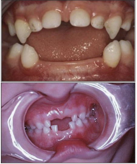<ol><li><p>Rare metabolic disease</p></li><li><p>Autosomal recessive</p></li></ol><p></p>