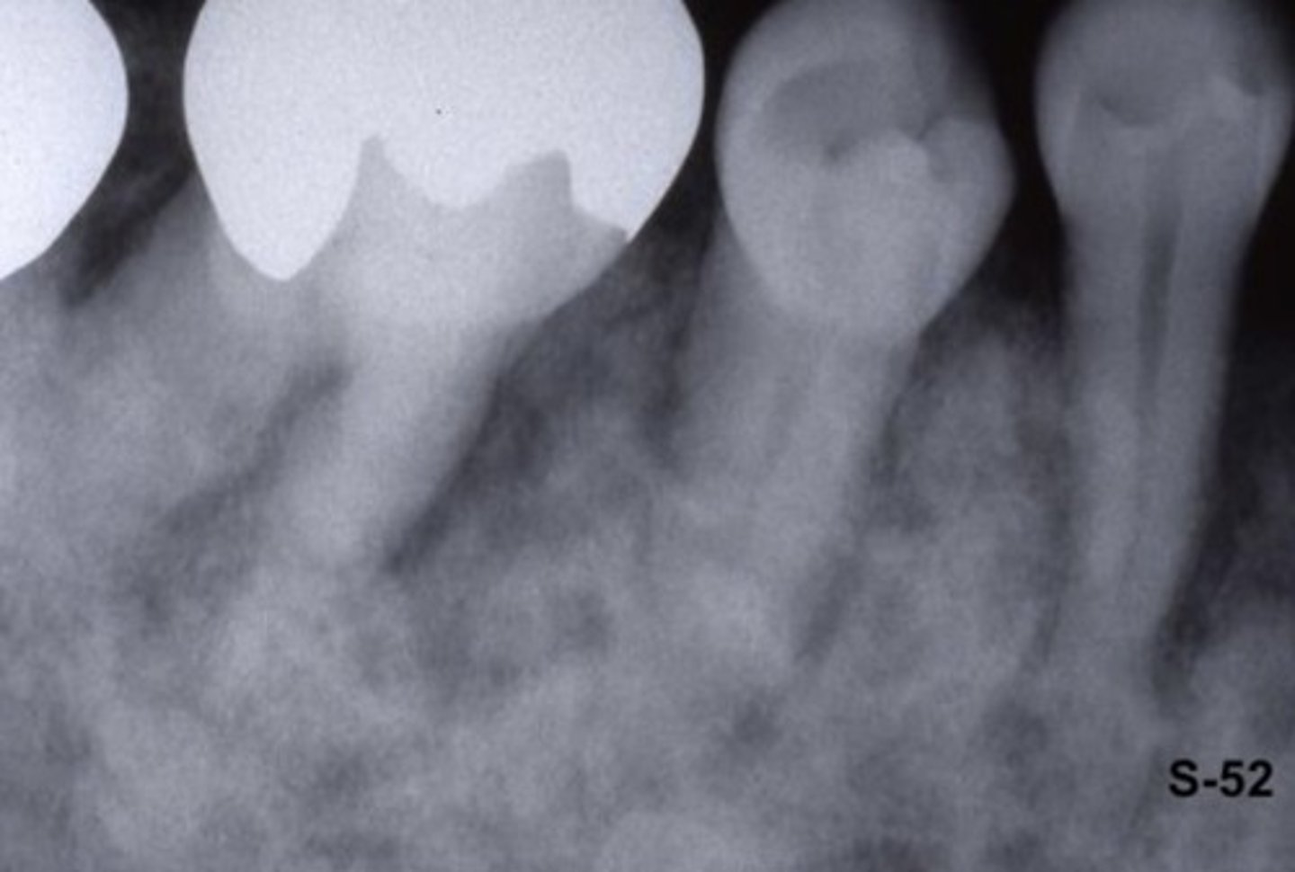 <p>What type of trabecular pattern is exhibited in this radiograph?</p>
