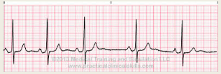 Sinus rhythm – P wave present, other measurements WNL

Slight irregularity in rhythm – usually associated with breathing patterns