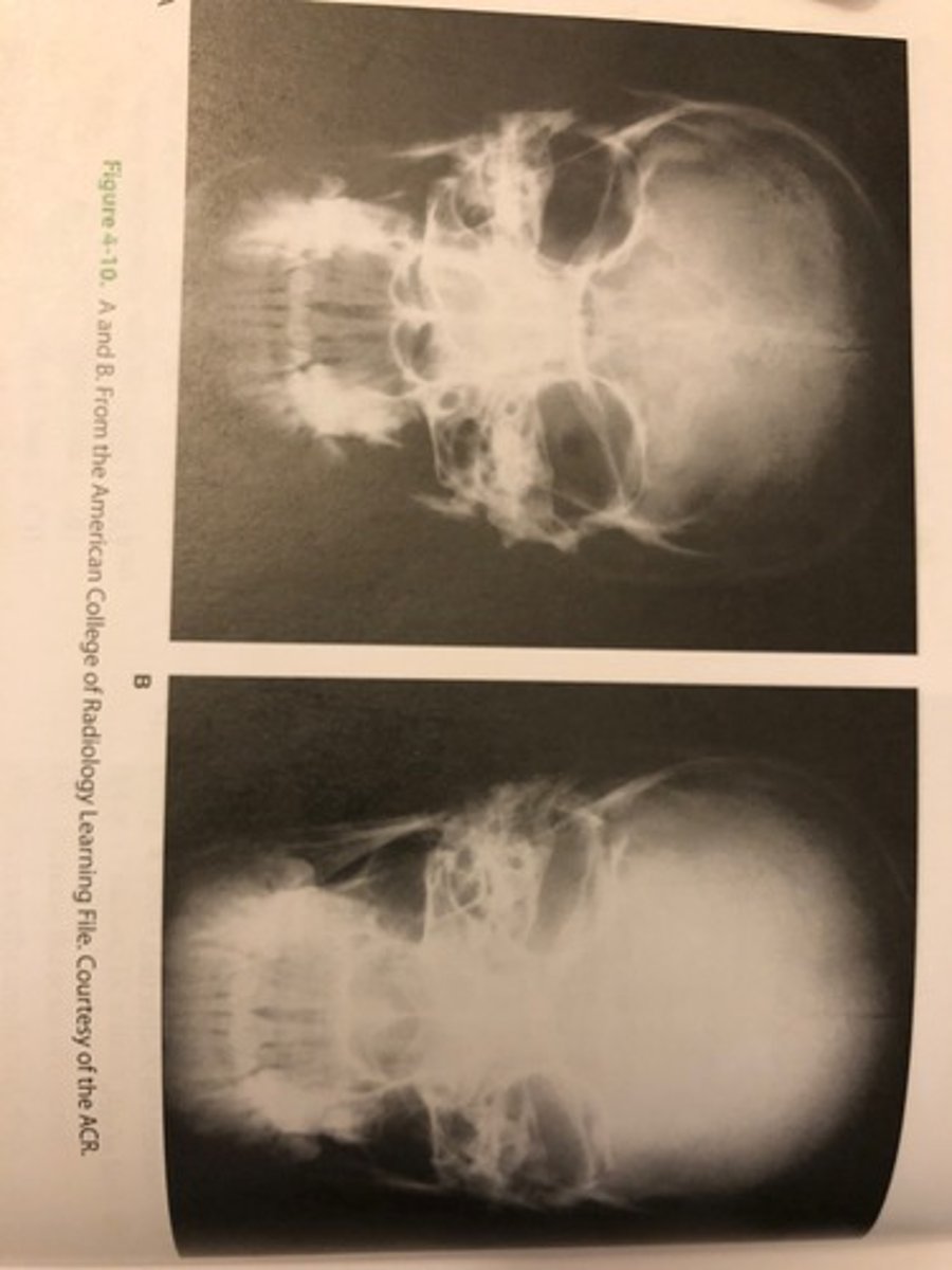 <p>(B) Image A demonstrates higher contrast</p>