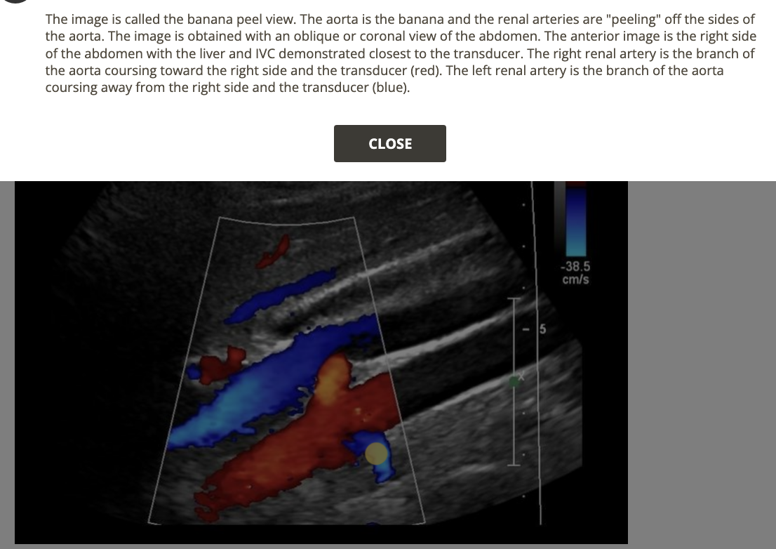 <p>IVC is on the RIGHT side of AO</p>