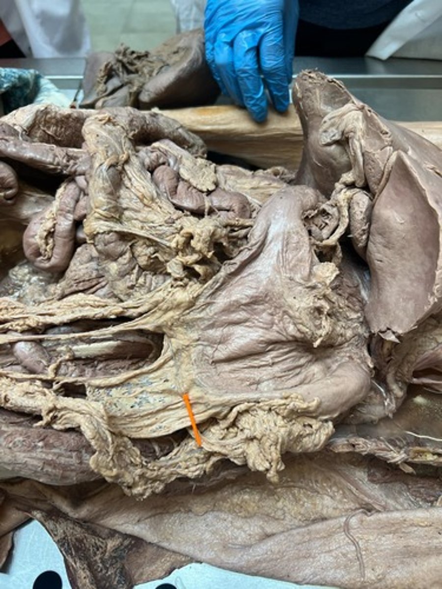 <p>greater omentum</p>