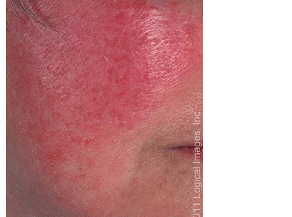 <p>what condition?</p><ul><li><p>inflammatory acneiform disorder of facial pilosebaceous units</p></li><li><p>facial flushing</p></li><li><p>papules/pustules localized to central face</p></li><li><p>telangiectasias</p></li><li><p><strong>no comedones</strong></p></li><li><p>+ /- burning, phymatous changes (tissue hypertrophy, nodules), ocular manifestations</p></li></ul><p></p>