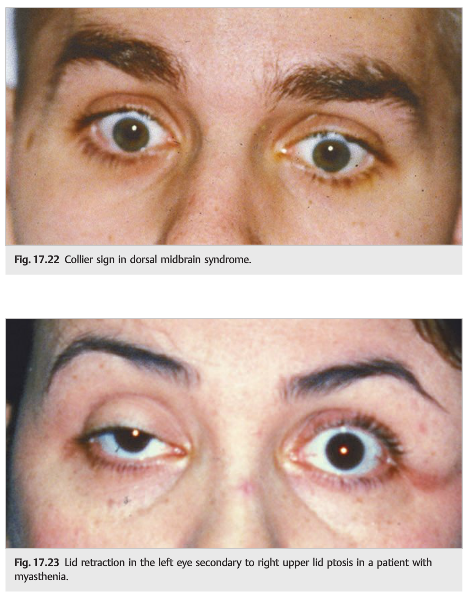 <p>collier sign/bilateral eyelid retraction</p><p>also w/ light-near dissociation (pupils reactive to accommodation but not light), limitation of upward gaze</p>