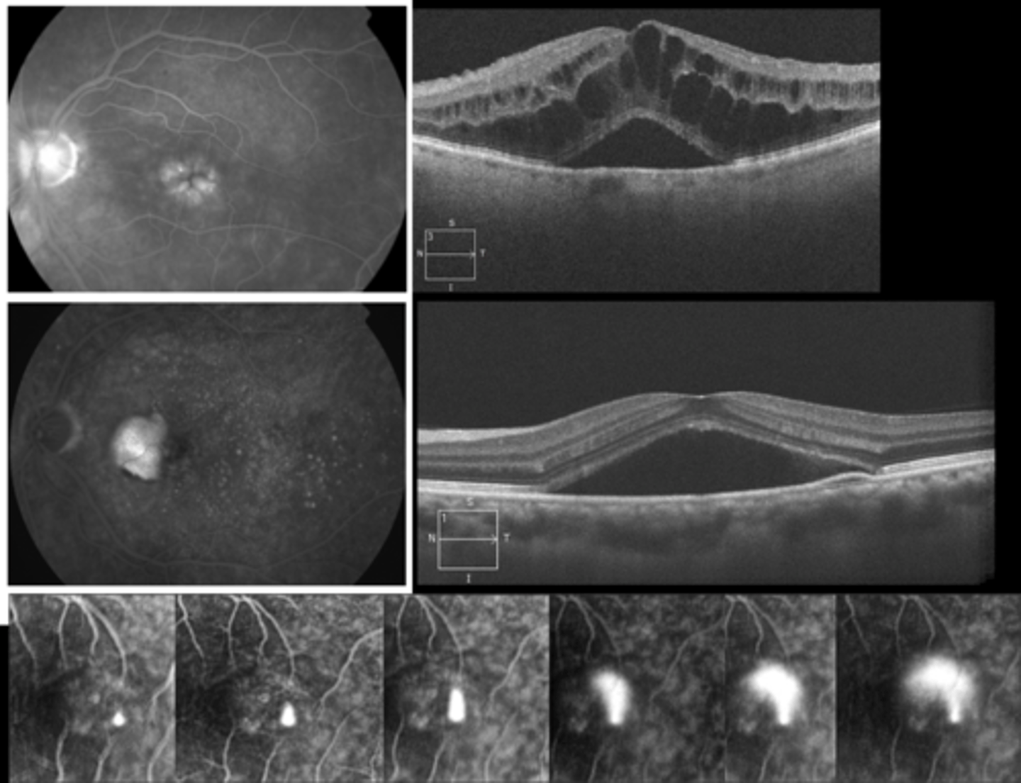 <p>retinal edema like CSR</p><p>sensory retinal detachment (fuzzy borders)</p><p>RPE detachment (distinct borders)</p>