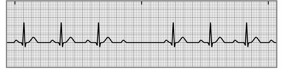 <p>is a condition where there are intermittent failures in the conduction of electrical impulses from the atria to the ventricles, typically seen on an EKG as progressively prolonged PR intervals followed by a dropped QRS complex. </p>