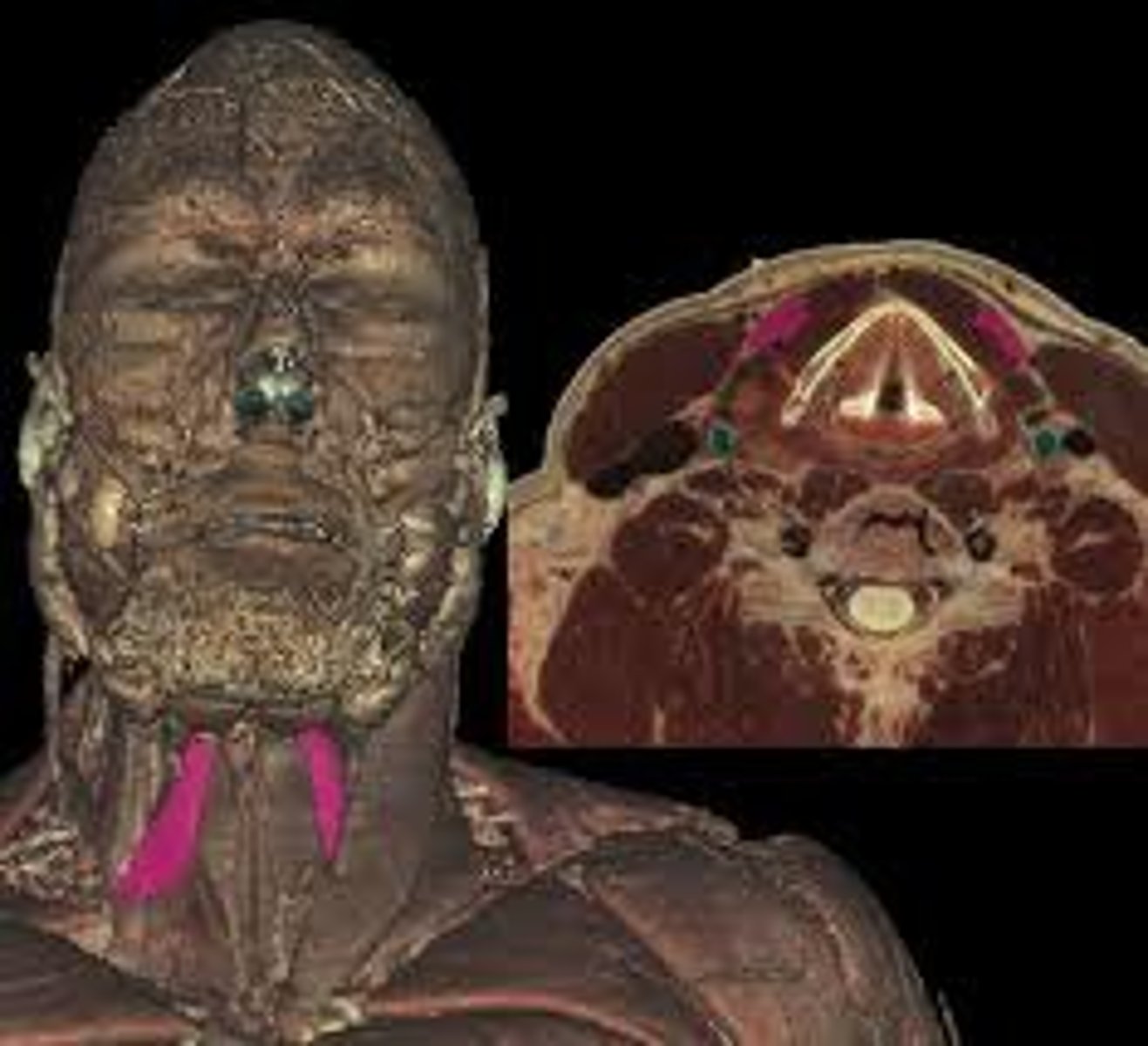 <p>Origin: scapula</p><p>Insertion: Hyoid bone</p><p>Action: Depresses hyoid bone</p>