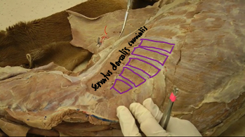 <p><span>Intercostal Muscles (thoracic wall)</span></p>