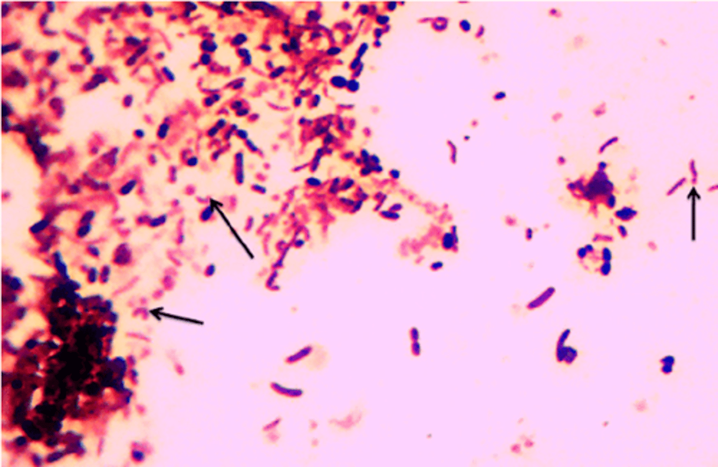 <p>Gram staining of fecal smear bacteria showing this characteristic "gull-winged rods" would lead to suspicion of which causitive agent?</p><p>A. Leptospira serovar Icterohemmorhagiae</p><p>B. Listeria monocytogenes</p><p>C. Campylobacter jejuni</p><p>D. Helicobacter pylori</p>