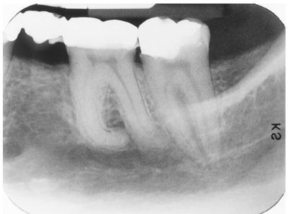 <p>Select the most appropriate term for the anomaly associated with the 1st molar.</p><p> </p><p>diastema</p><p> </p><p>concrescence</p><p> </p><p>dilaceration</p>