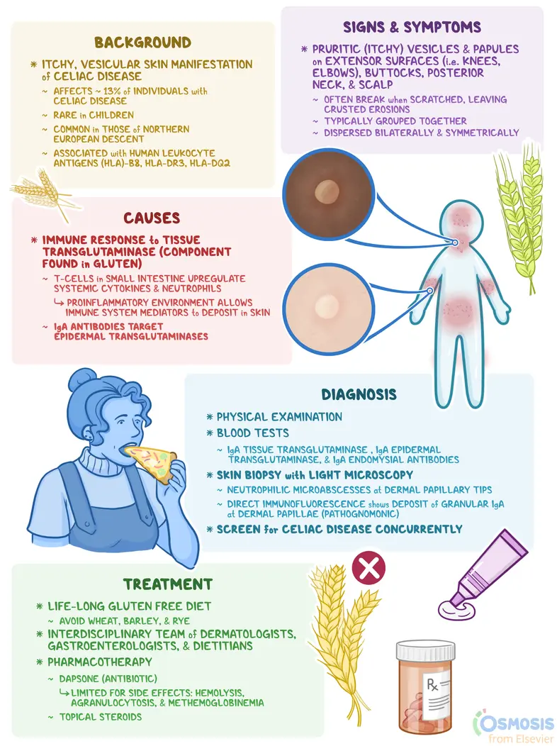 <p>E: gluten<br>celiac disease (90% of pts)</p><p>CM: itchy papules/vesicles<br>-elbows<br>-knees<br>-buttock<br>-posterior neck<br>-scalp</p><p>DX: punch biopsy<br>celiac dx→tissue transglutamase</p><p>TX: strict gluten-free diet<br>PO dapsone</p>