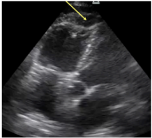 <p>What is McConnel’s sign?</p><p>*for R. heart strain → PE; A4C</p>
