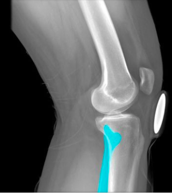 Description:
Long, thin bone
Articulates with tibia (proximal) and
talus (distal)
Characteristic features include head,
neck, shaft, and lateral malleolus