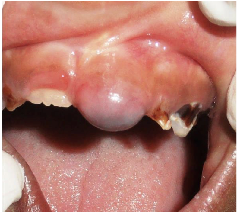 <p>7-year old male patient, which presented as a swelling involving the gingiva overlying the crown of 21</p>