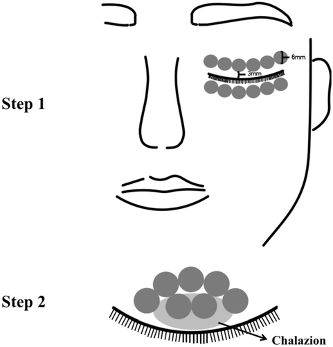 <p>antimicrobial effect</p><p>anti-inflammatory effect</p><p>kills demodex = targets melanin-like chromophore in backbone, also inhibits reproduction</p>