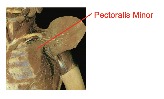 <p>Pectoralis minor</p><p></p><p>Origin</p><ul><li><p>anteiror surcface of ribs 3-5</p></li></ul><p>insertion</p><ul><li><p>coracoid process of scapula</p></li></ul><p></p><img src="https://knowt-user-attachments.s3.amazonaws.com/a6393621-7374-470e-93f2-29dcc38b0eea.png" data-width="100%" data-align="center"><p></p>