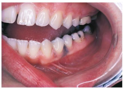 <p>Fragments of amalgam embedded in adjacent soft tissue during restoration → aka Amalgam tattoo.&nbsp;</p><ul><li><p>Clinically seen as blue-ish pigmentation in the gingiva</p></li></ul><p></p>