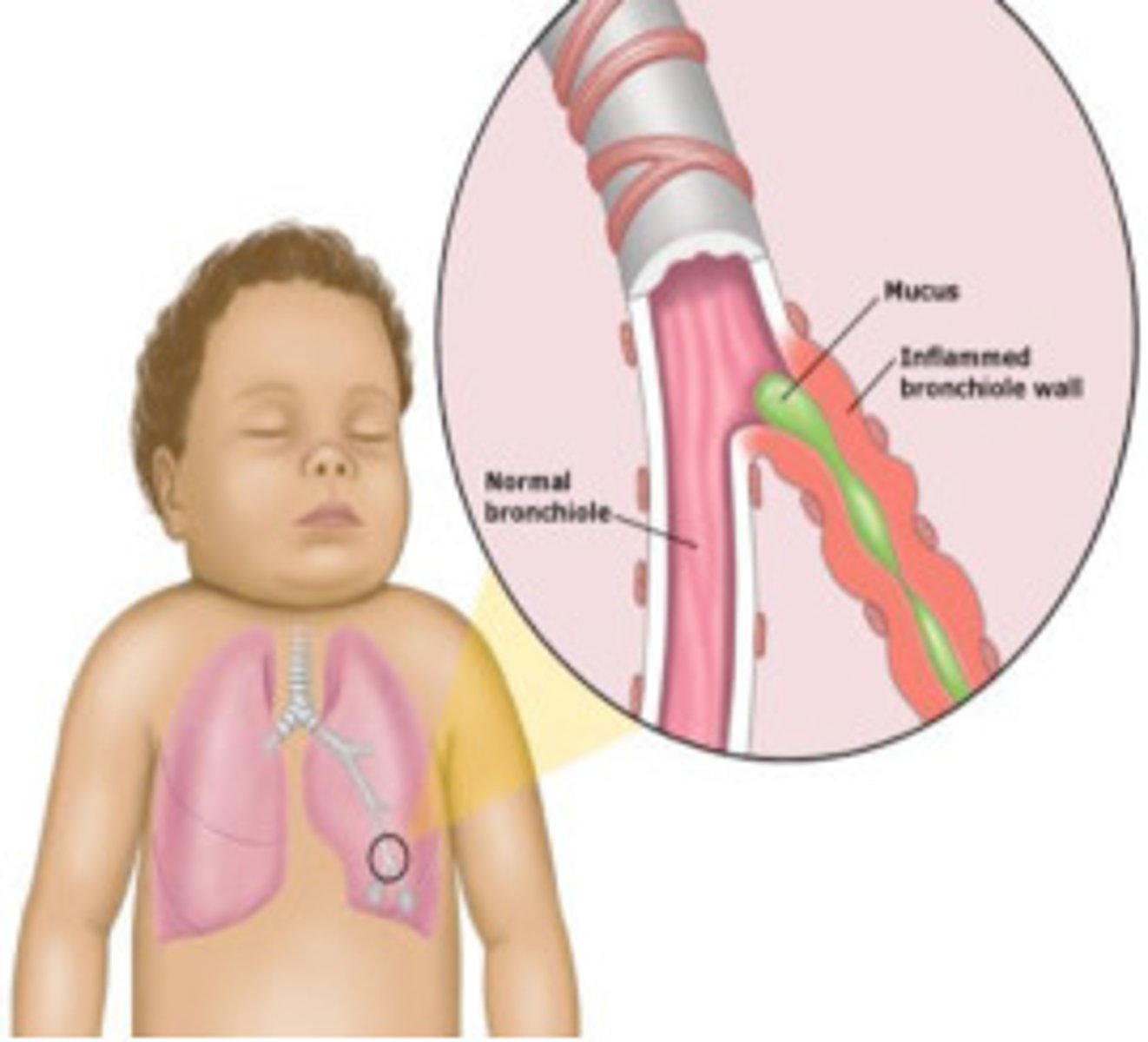<p>Barking cough, inspiratory stridor, hoarseness</p>