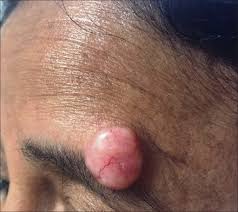<p>nodule</p>