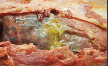 <p>acute, yellow-tan fibrin exudate, easily peeled from serosal surfaces</p>
