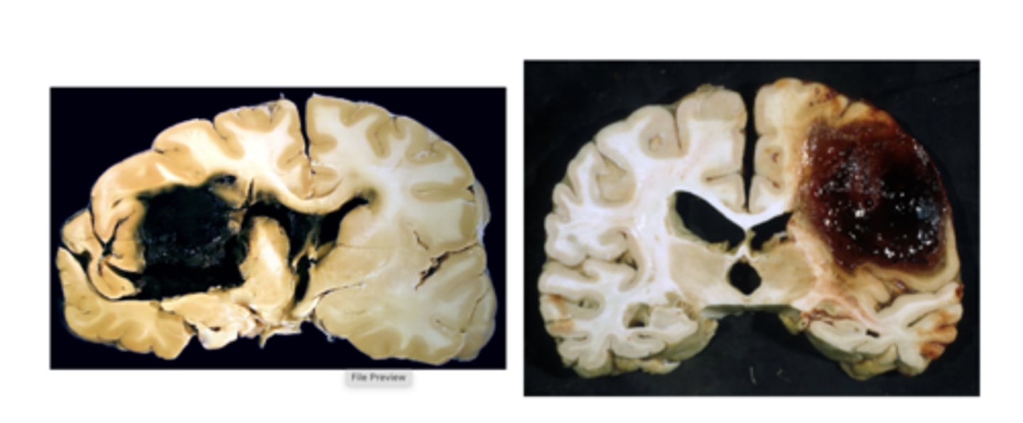 <p>intracerebral hemorrhage</p><p>Subarachnoid hemorrage</p>