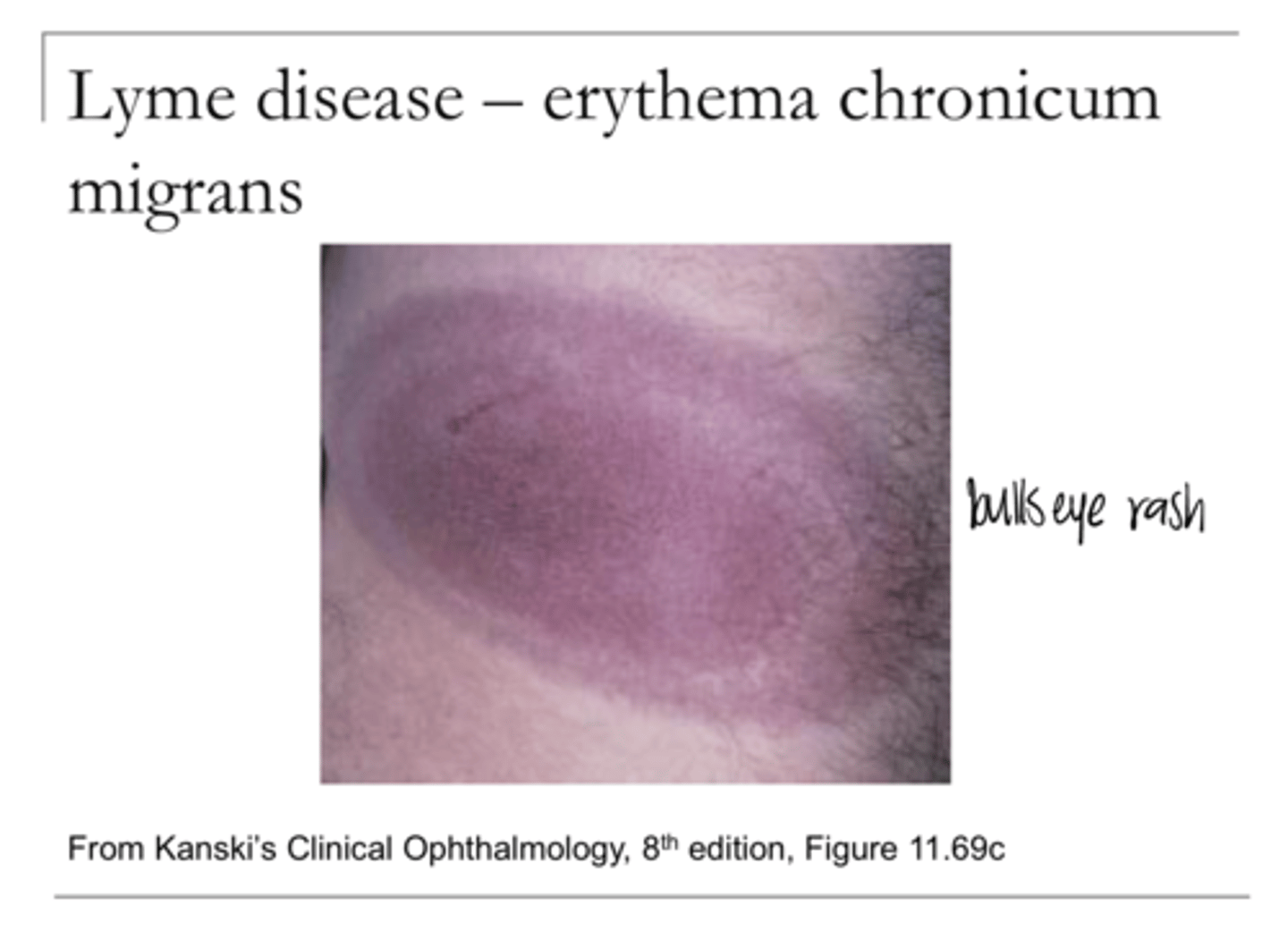 <p>What are the early systemic manifestations of Lyme Disease?</p>