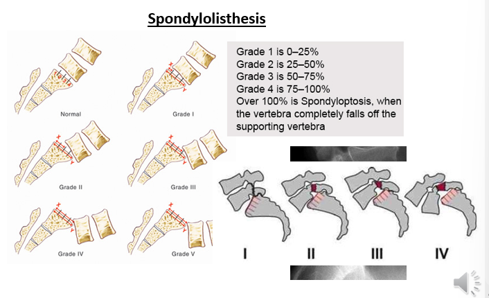 <p>Graded I – IV based on degree of anterior displacement</p><p></p><p>1 = 0-25%</p><p>2 = 25-50%</p><p>3 = 50-75%</p><p>4 = 75-100%</p><p></p><p>Over 100% is spondyloptosis, when the vertebra completely falls off the supporting vertebrae</p>