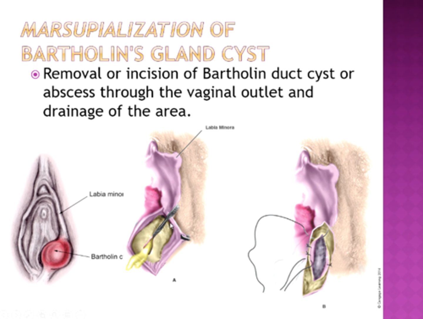 <p>Marsupialization (a surgical procedure where a cyst is opened and sutured to the surrounding tissue to create a permanent drainage pathway, preventing reformation)</p>