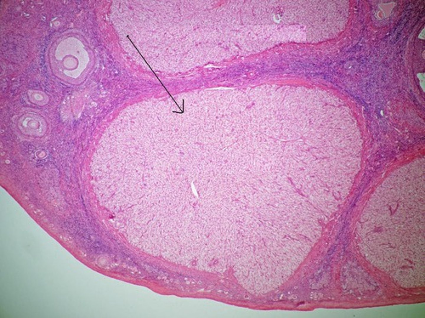 <p>empty ovarian follicle that secretes progesterone after release of the egg cell</p>