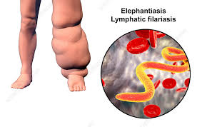 <p><span>infects the lymph nodes, usually producing a non-lethal but deforming condition called&nbsp;</span>elephantiasis</p>