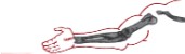 <ol><li><p>Is this image of the arm normal or abnormal?</p></li><li><p>If abnormal, what pathology is seen here?</p></li></ol><p></p>