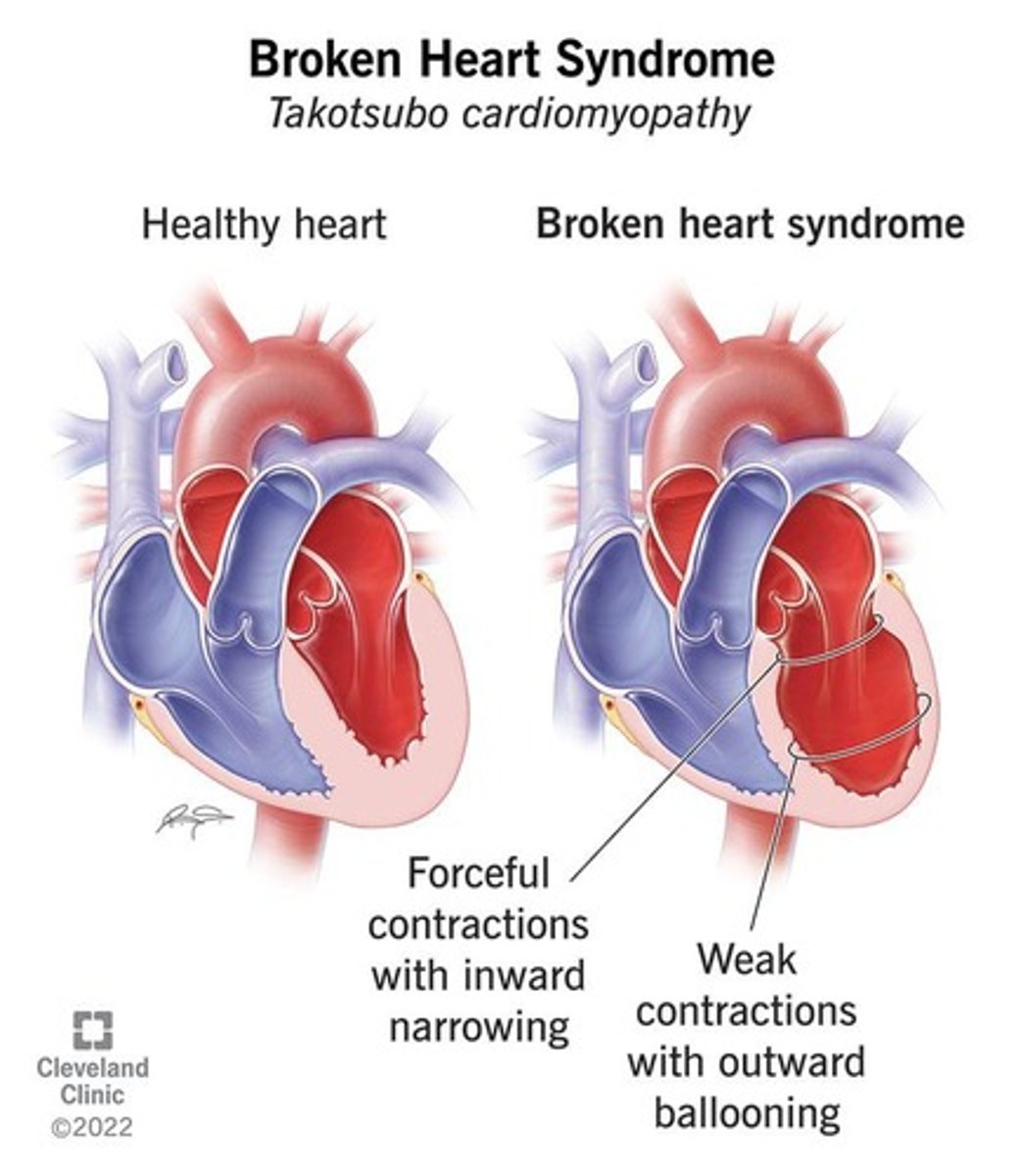 <p>A condition that mimics a heart attack, triggered by sudden emotional stress, characterized by symptoms like dyspnea and chest pain.</p>