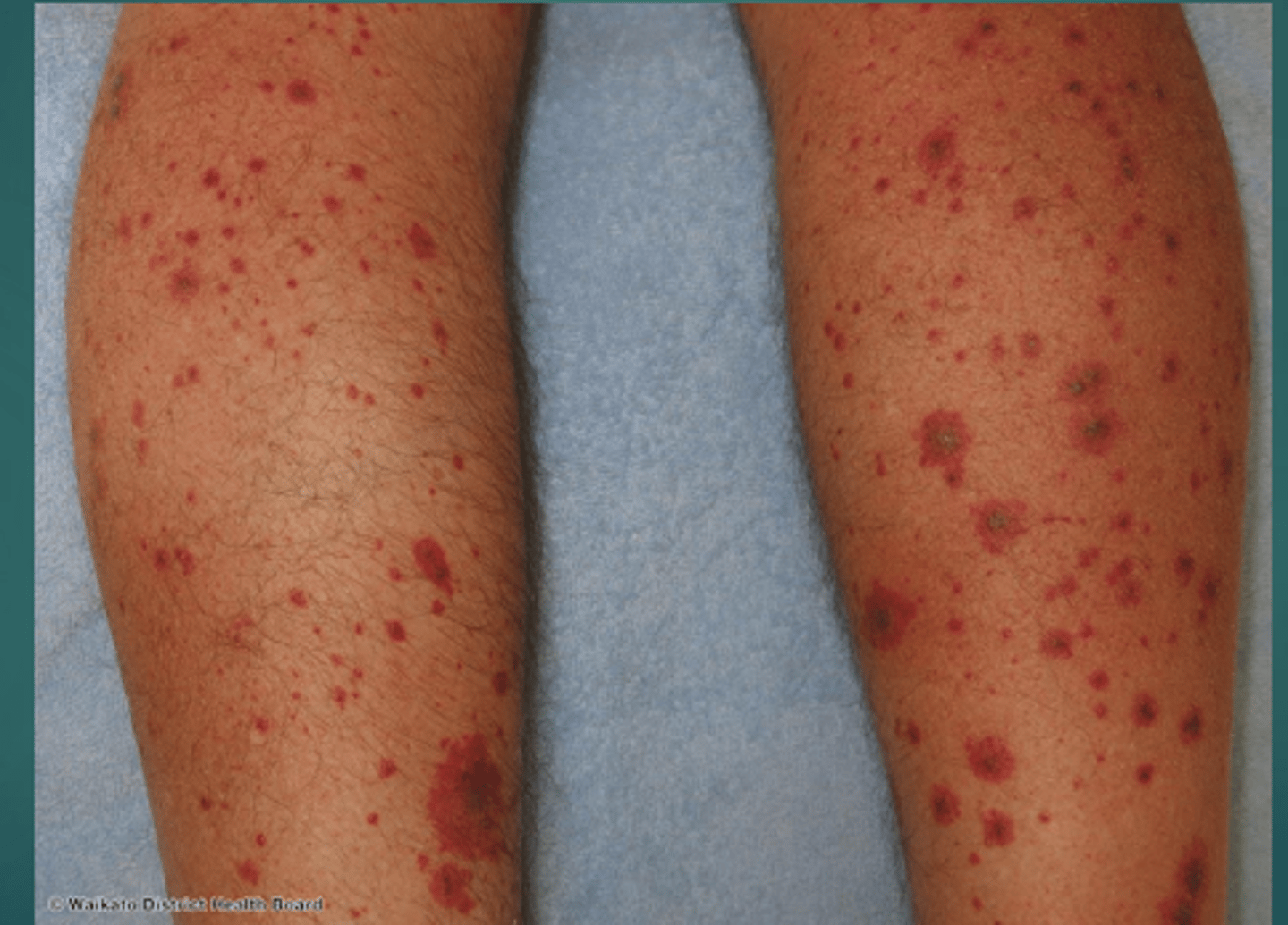 <p>Allergic cutaneous vasculitis</p>
