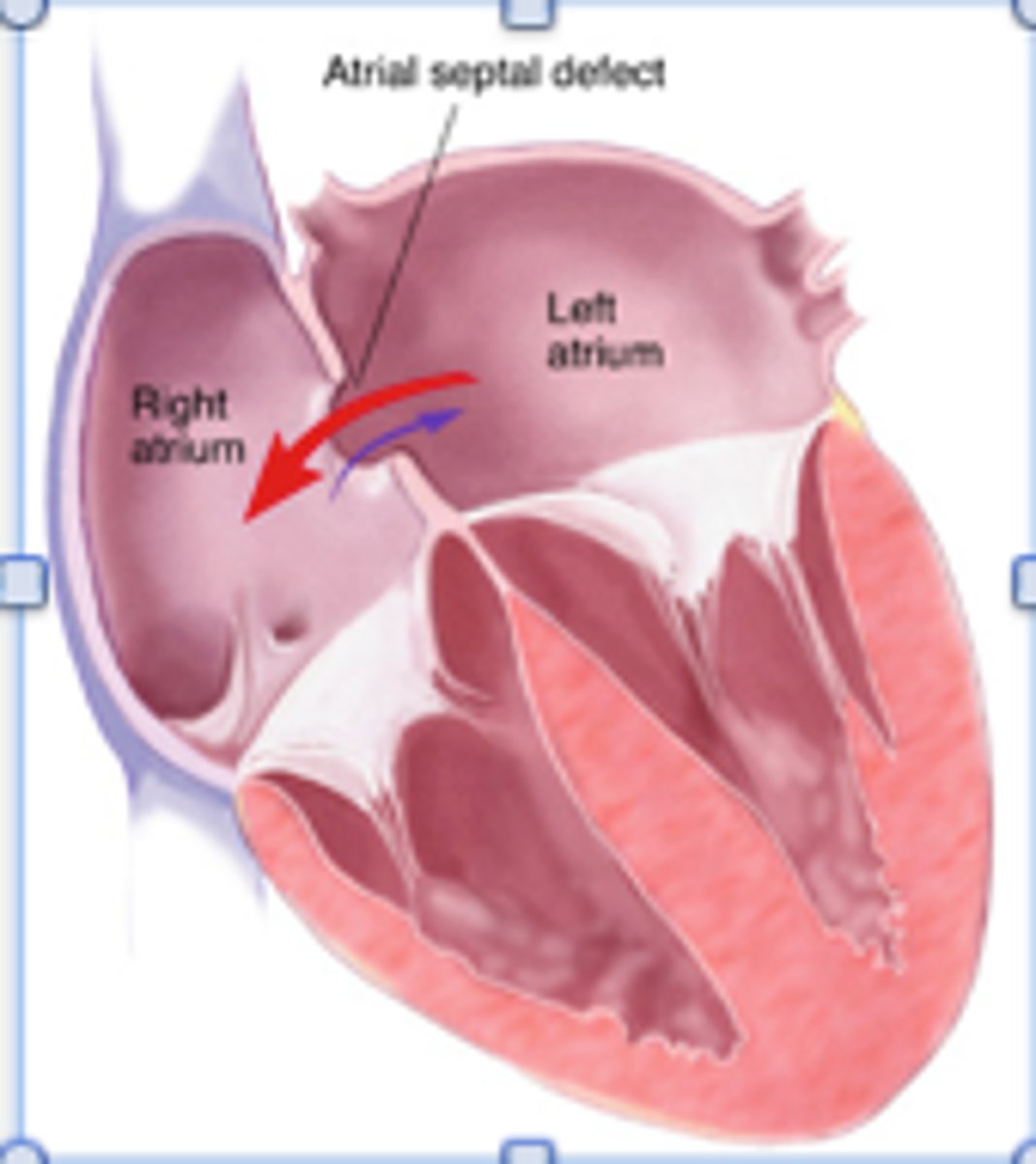 <p>hole between the atria</p><p>- Causes right heart overload</p><p>- mild, no symptoms</p>