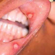 <p><span style="color: red;"><span>common</span></span><span> oral mucosal disease</span></p><p><span>ulcerations with </span><span style="color: red;"><span>no known cause </span></span><span>and a wide spectrum of severity and </span><span style="color: red;"><span>frequency of recurrence</span></span></p><ul><li><p><strong>triggers:</strong></p><ul><li><p>represent an<span style="color: red;"> autoimmune reaction</span></p></li><li><p>precipitated by <span style="color: red;">stress or hormonal changes</span></p></li><li><p>associated with systemic conditions such as <span style="color: red;">vitamin deficiencies, iron deficiency</span>, and inflammatory bowel diseases.</p></li></ul></li></ul><ul><li><p><strong>treatment:</strong></p><ul><li><p><span style="color: red;">topical steroids</span> for recurrent cases</p></li></ul></li></ul><p></p>
