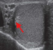 <p>What part of the testicle is seen here?</p>