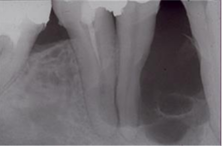 <p>most associated w a tumor over a cyst </p>