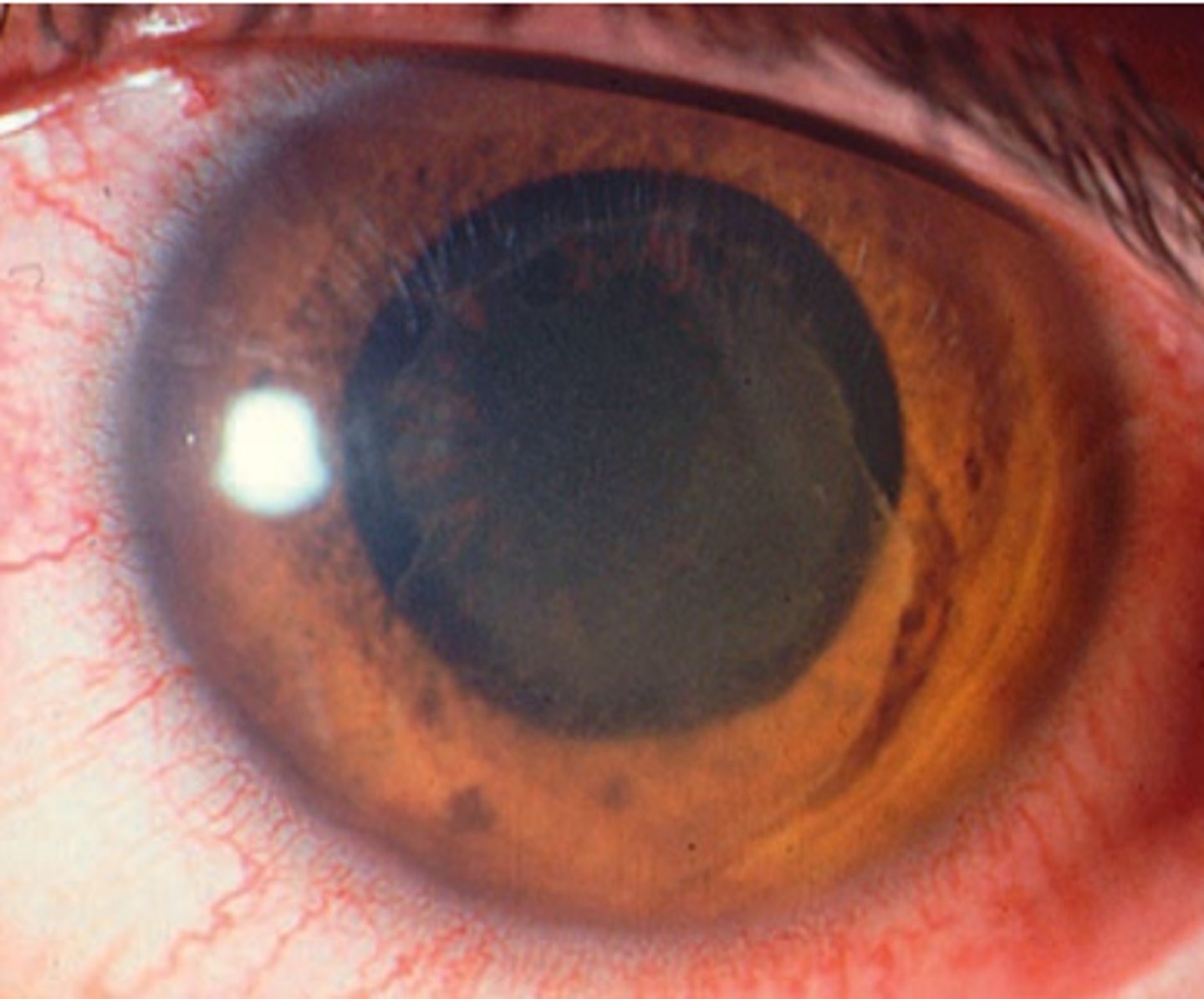 <p>coagulation of protein and inflammatory cells forming a sheet like substance in the anterior chamber. Is a severe, but rare, anterior chamber reaction. Is more common in darkly pigmented irises.</p>